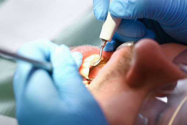 Best Emergency Root Canal Treatment in Chevy Chase, MD